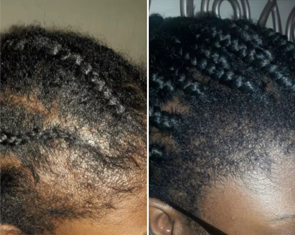 Huile de traitement en profondeur - huile de croissance pour les cheveux